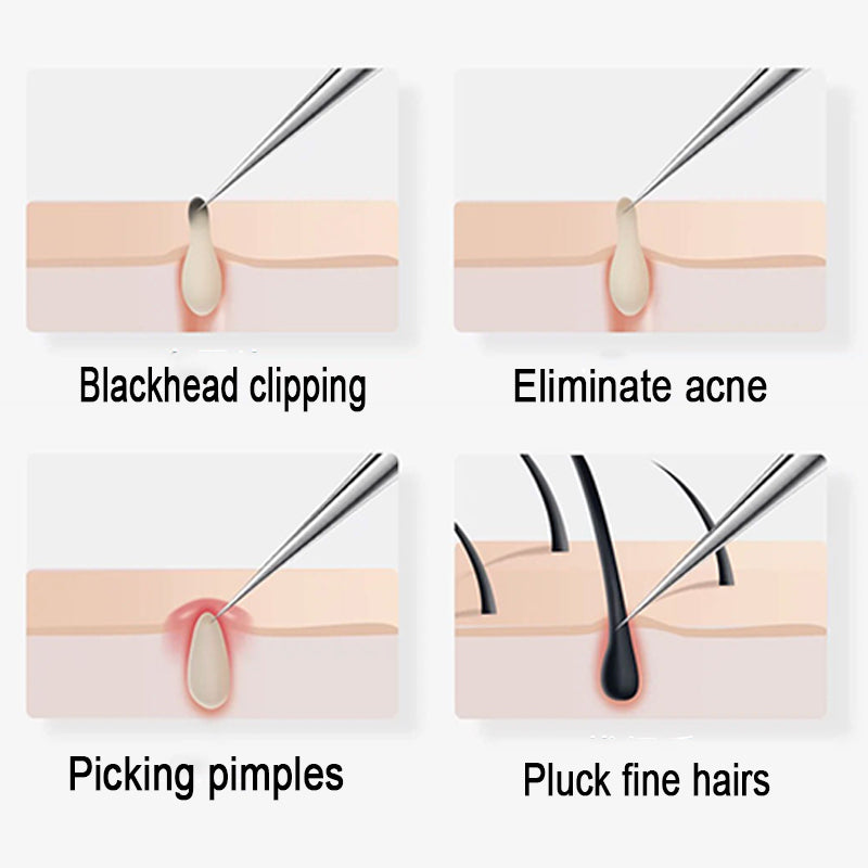 4–5 Piece Acne Needle & Blackhead Tweezer Tool Set